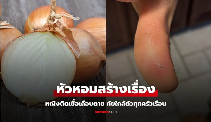 หญิงทำอาหาร เกือบตายเพราะปอก "หัวหอม" ติดเชื้ออันตรายคาดไม่ถึง ภัยใกล้ตัวทุกครัวเรือน